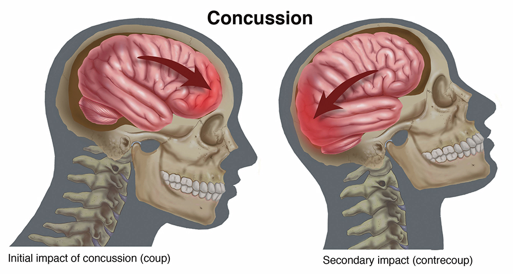 Movie martial arts knockout brain concussion 2