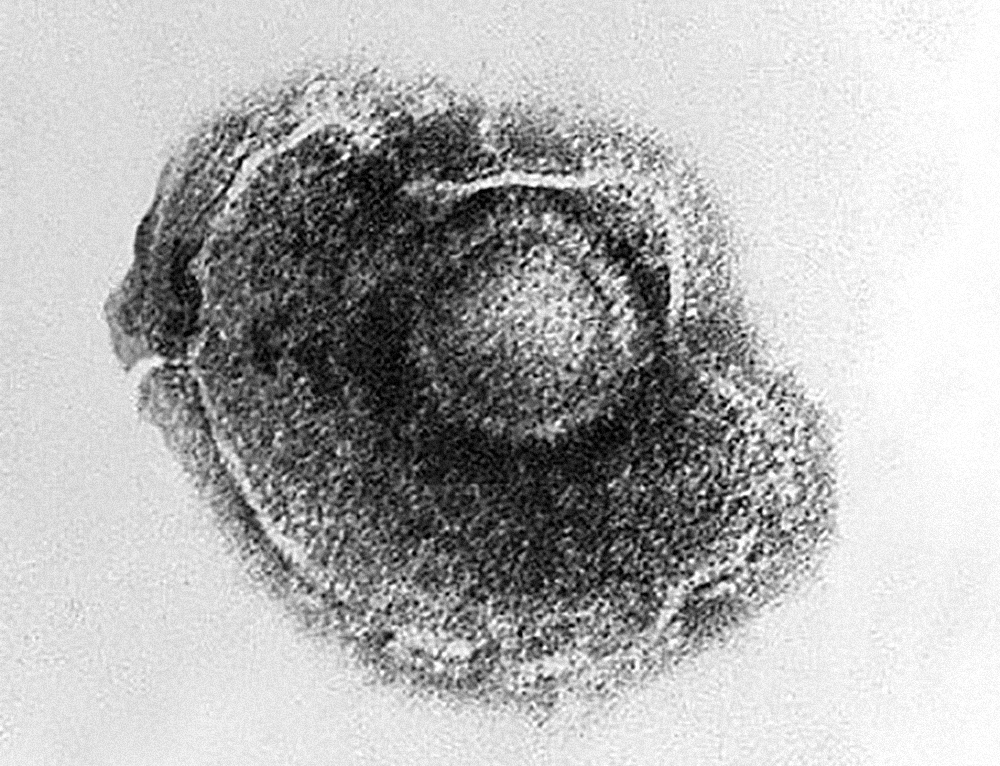 An electron micrograph of the varicella zoster virus (VZV) known as chickenpox. Source: Wikipedia / CDC